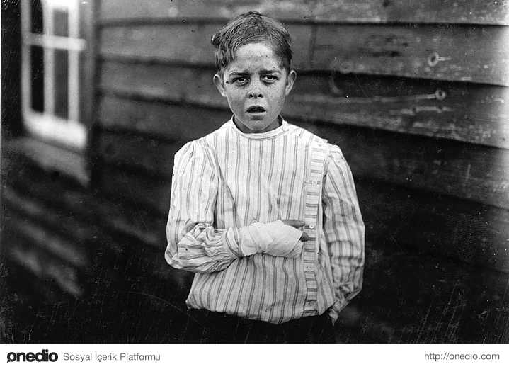 Bir fabrikada çalışan Giles Edmund Newsom isimli yaralı çocuk işçi. Hikayesi ise şöyle: Giles fabrikada çalışırken bir makine parçası ayağına düşüyor  ve ayak parmağını eziyor. Bu da dengesini kaybedip bir makineye elini kaptırmasına ve iki parmağının kopmasına sebep oluyor.(1912)